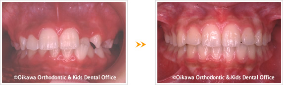子どもの矯正歯科の症例