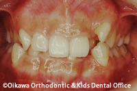 深い咬み合わせ