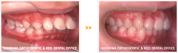 出っ歯の矯正