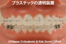 プラスチック製の目立たない矯正装置